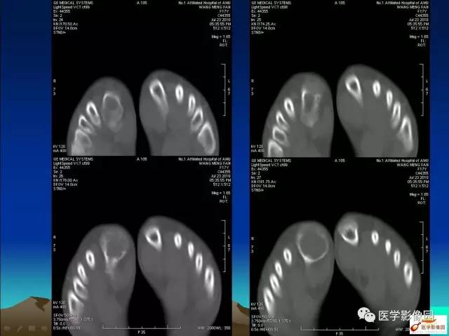 【病例】趾骨骨巨细胞瘤1例CT影像表现 【病例】趾骨骨巨细胞瘤1例CT影像表现