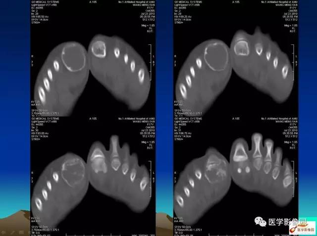 【病例】趾骨骨巨细胞瘤1例CT影像表现 【病例】趾骨骨巨细胞瘤1例CT影像表现