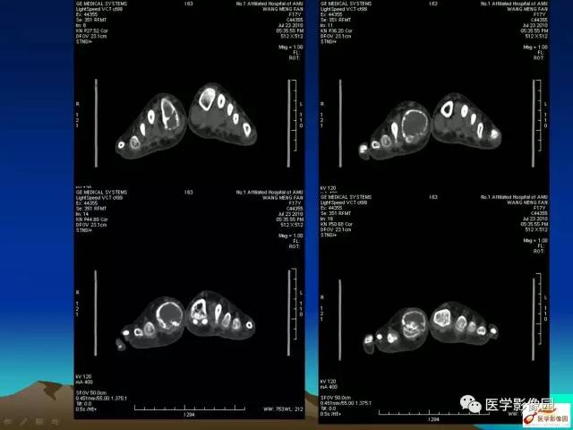 【病例】趾骨骨巨细胞瘤1例CT影像表现 【病例】趾骨骨巨细胞瘤1例CT影像表现