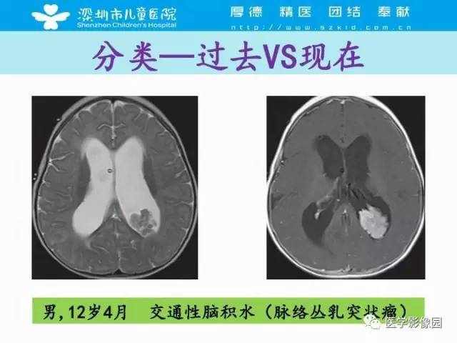 【PPT】儿童脑积水的MRI检查规范及新进展