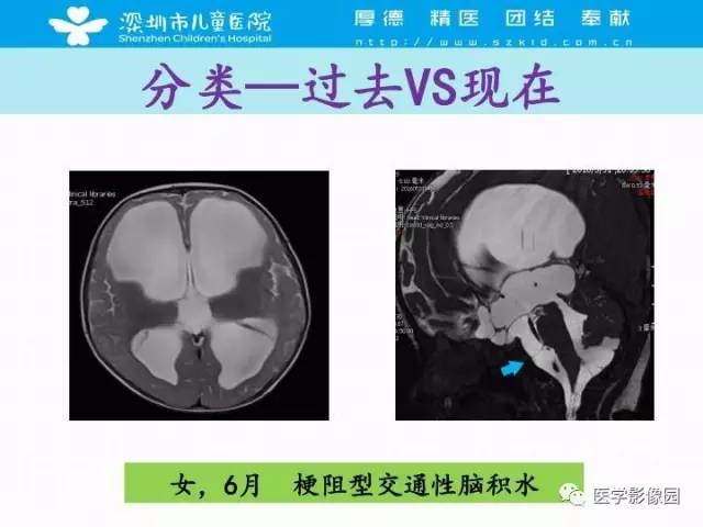 【PPT】儿童脑积水的MRI检查规范及新进展