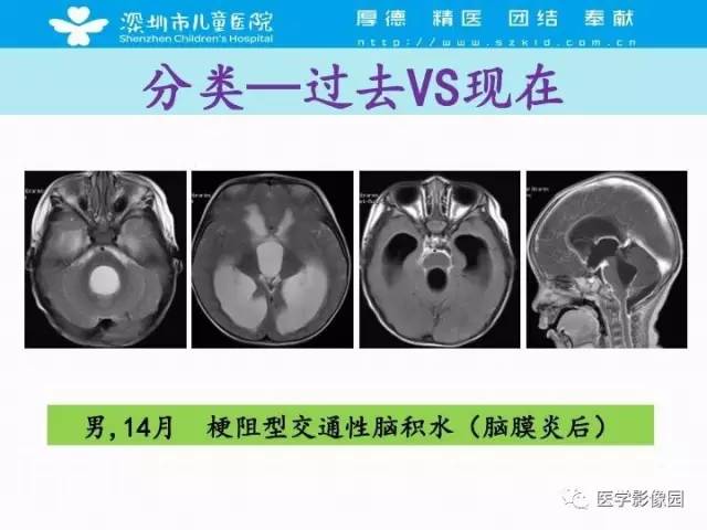 【PPT】儿童脑积水的MRI检查规范及新进展