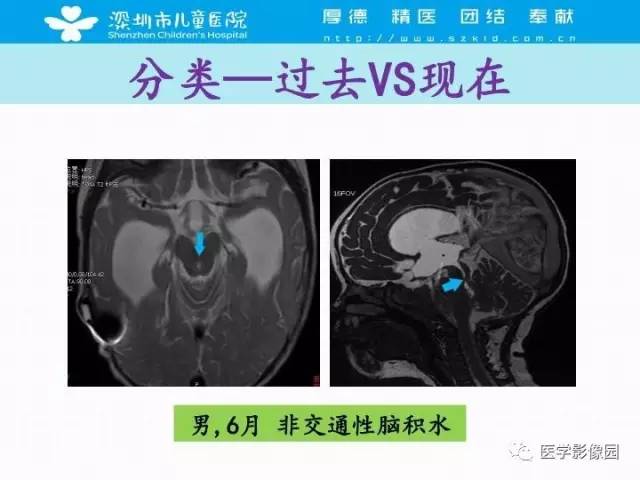 【PPT】儿童脑积水的MRI检查规范及新进展