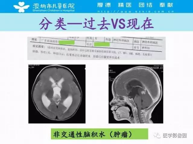 【PPT】儿童脑积水的MRI检查规范及新进展