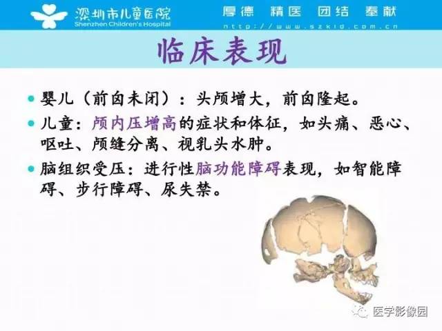 【PPT】儿童脑积水的MRI检查规范及新进展