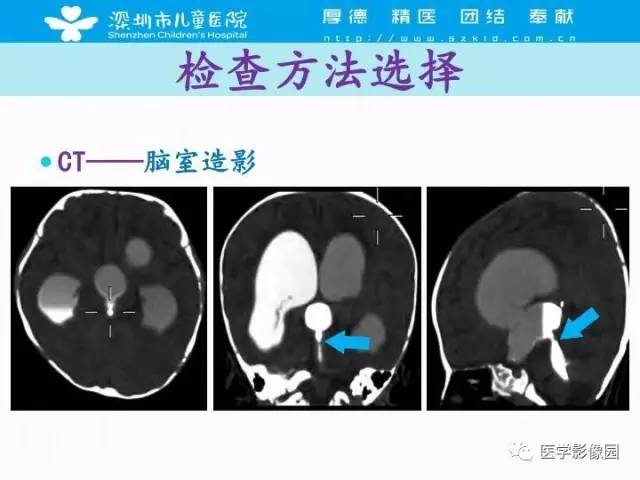 【PPT】儿童脑积水的MRI检查规范及新进展