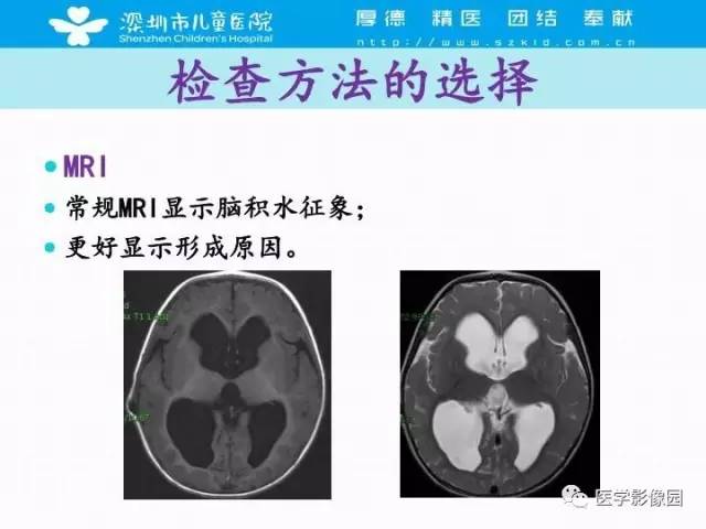 【PPT】儿童脑积水的MRI检查规范及新进展
