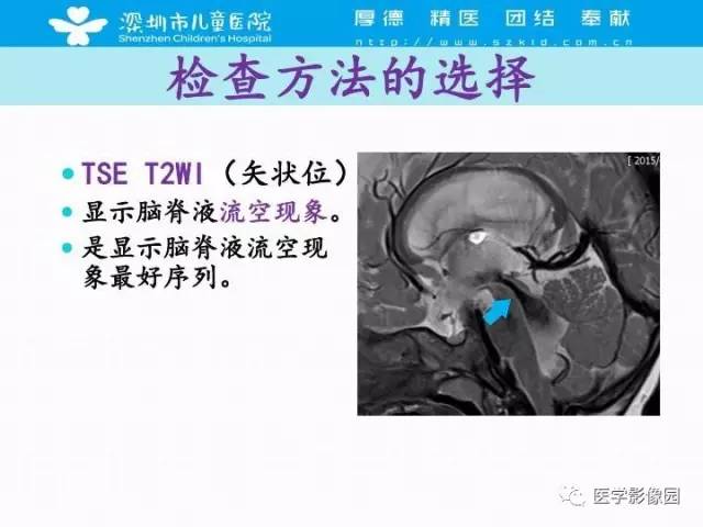 【PPT】儿童脑积水的MRI检查规范及新进展