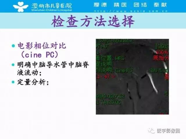 【PPT】儿童脑积水的MRI检查规范及新进展