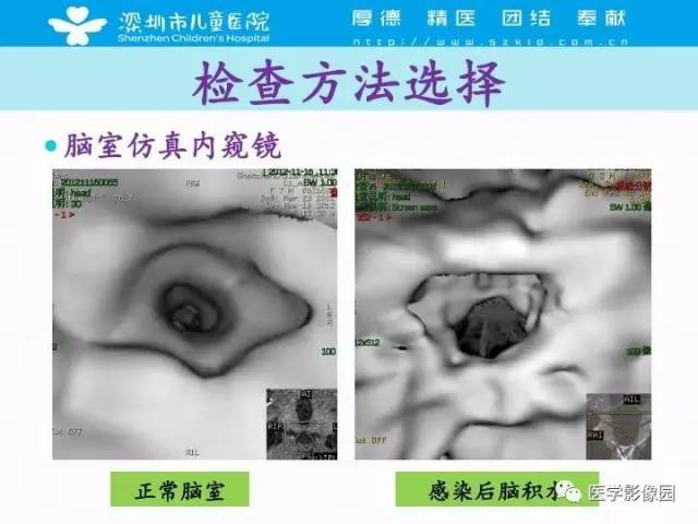 【PPT】儿童脑积水的MRI检查规范及新进展