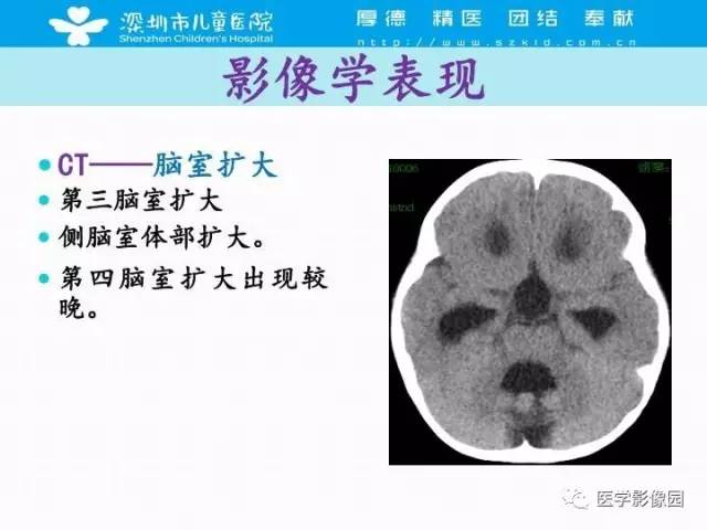 【PPT】儿童脑积水的MRI检查规范及新进展