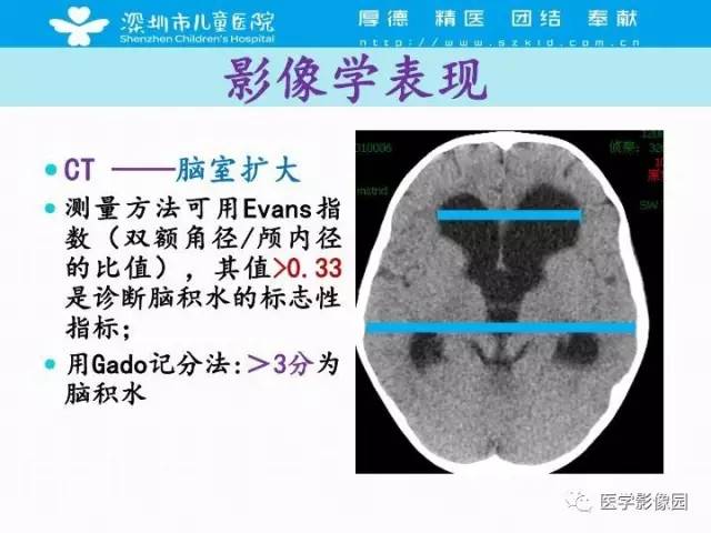 【PPT】儿童脑积水的MRI检查规范及新进展