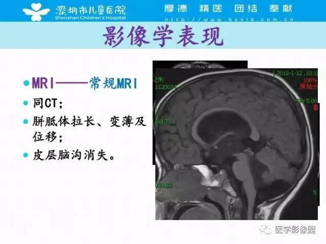 【PPT】儿童脑积水的MRI检查规范及新进展