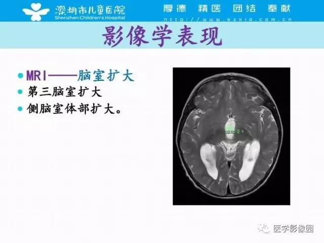 【PPT】儿童脑积水的MRI检查规范及新进展