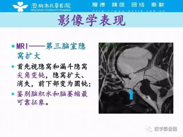 【PPT】儿童脑积水的MRI检查规范及新进展
