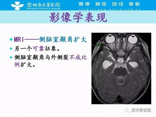 【PPT】儿童脑积水的MRI检查规范及新进展
