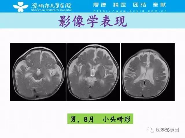 【PPT】儿童脑积水的MRI检查规范及新进展