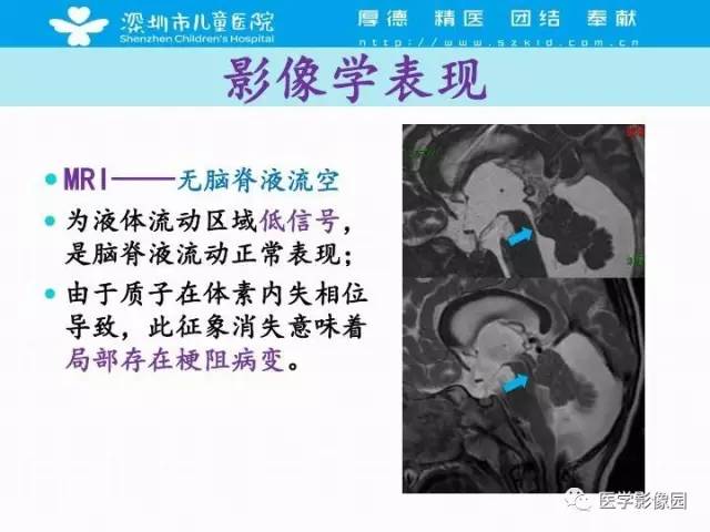 【PPT】儿童脑积水的MRI检查规范及新进展