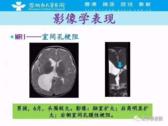 【PPT】儿童脑积水的MRI检查规范及新进展