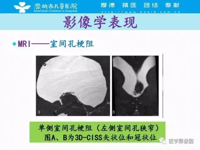 【PPT】儿童脑积水的MRI检查规范及新进展