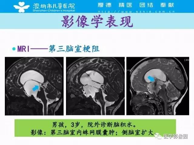 【PPT】儿童脑积水的MRI检查规范及新进展