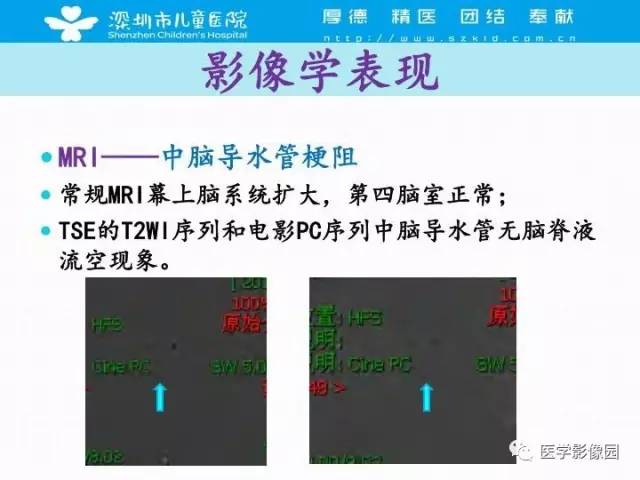 【PPT】儿童脑积水的MRI检查规范及新进展