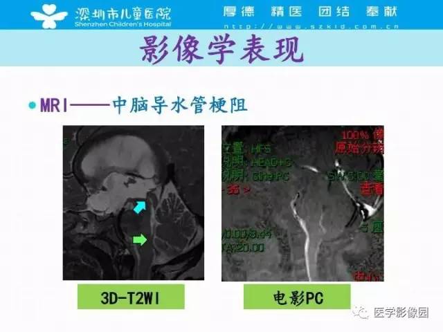 【PPT】儿童脑积水的MRI检查规范及新进展