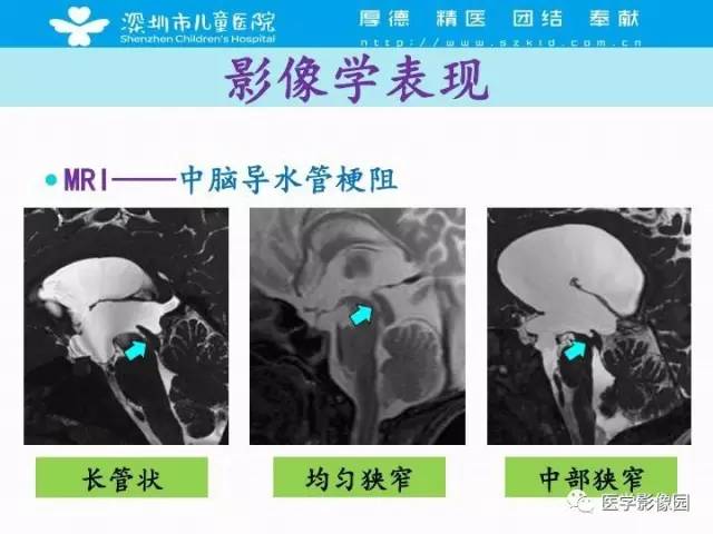 【PPT】儿童脑积水的MRI检查规范及新进展