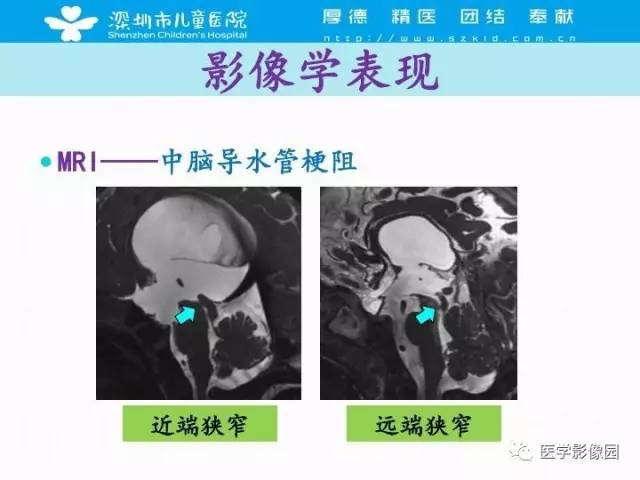 【PPT】儿童脑积水的MRI检查规范及新进展