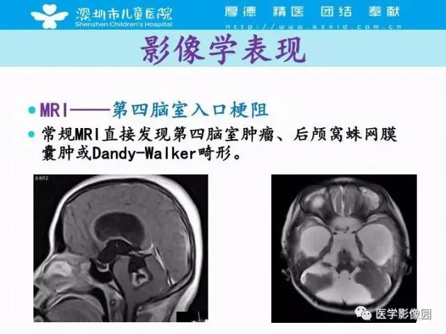 【PPT】儿童脑积水的MRI检查规范及新进展