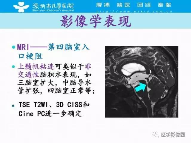 【PPT】儿童脑积水的MRI检查规范及新进展