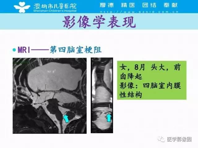 【PPT】儿童脑积水的MRI检查规范及新进展