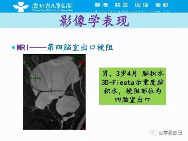 【PPT】儿童脑积水的MRI检查规范及新进展