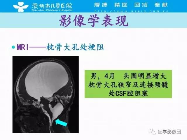 【PPT】儿童脑积水的MRI检查规范及新进展