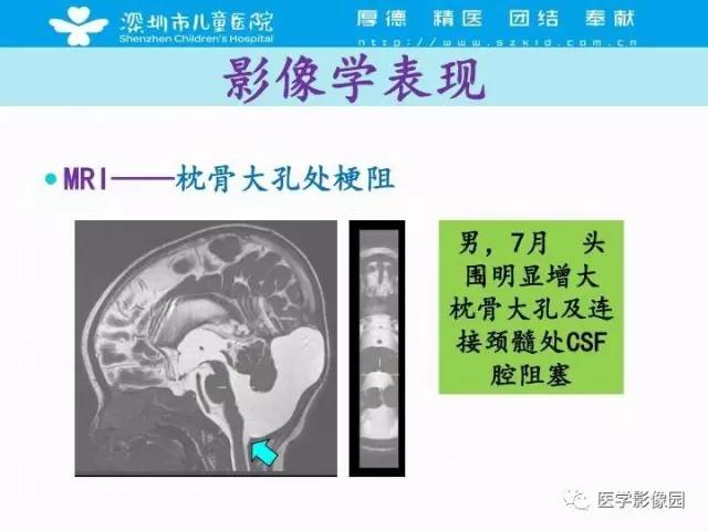 【PPT】儿童脑积水的MRI检查规范及新进展