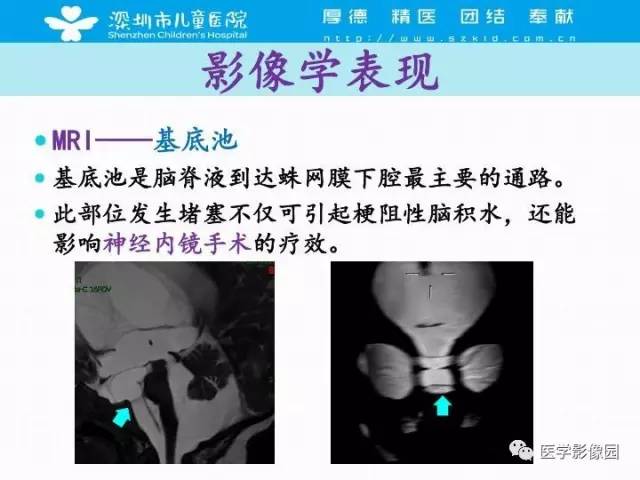 【PPT】儿童脑积水的MRI检查规范及新进展