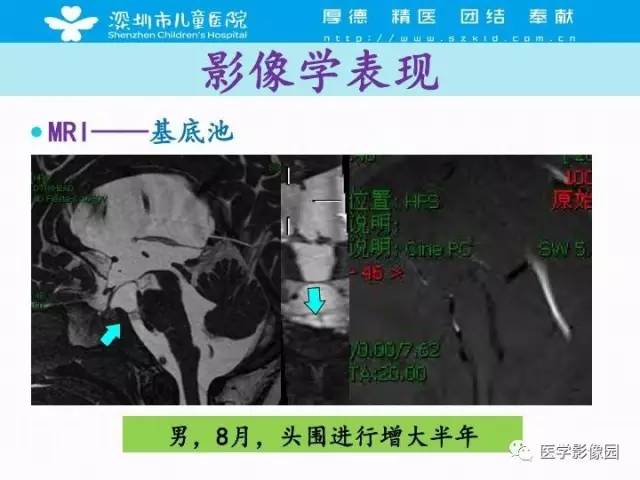 【PPT】儿童脑积水的MRI检查规范及新进展
