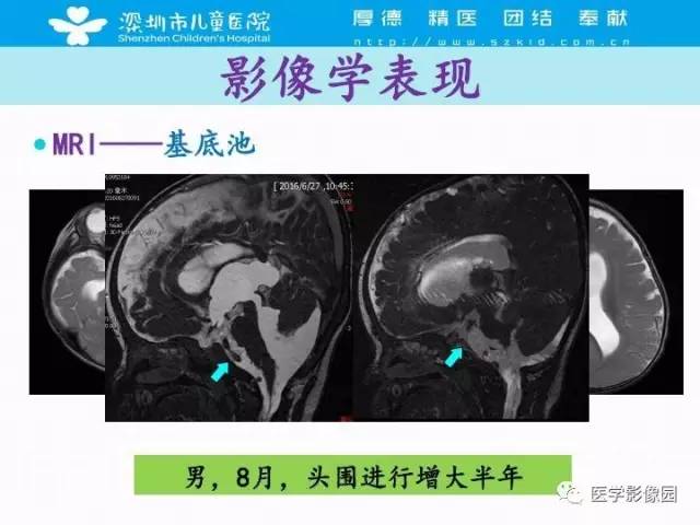【PPT】儿童脑积水的MRI检查规范及新进展