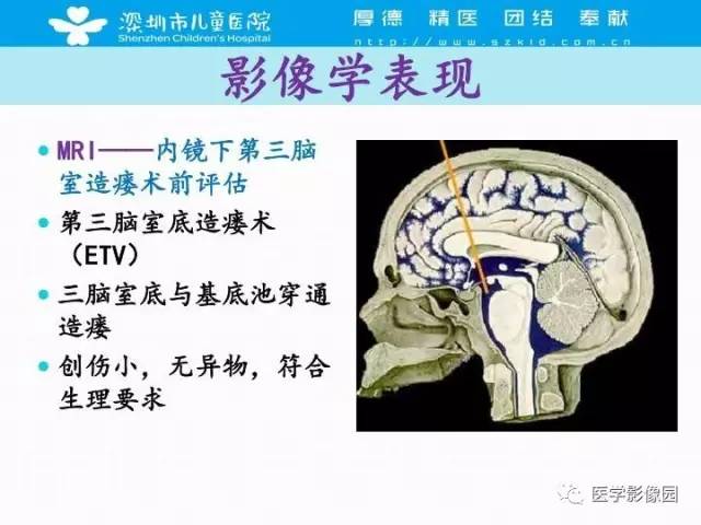 【PPT】儿童脑积水的MRI检查规范及新进展
