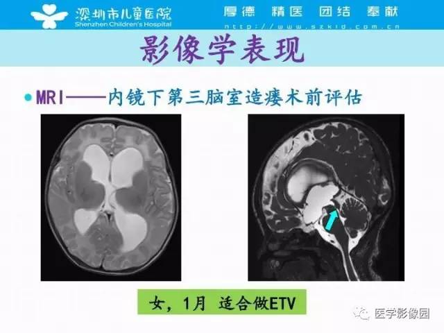 【PPT】儿童脑积水的MRI检查规范及新进展