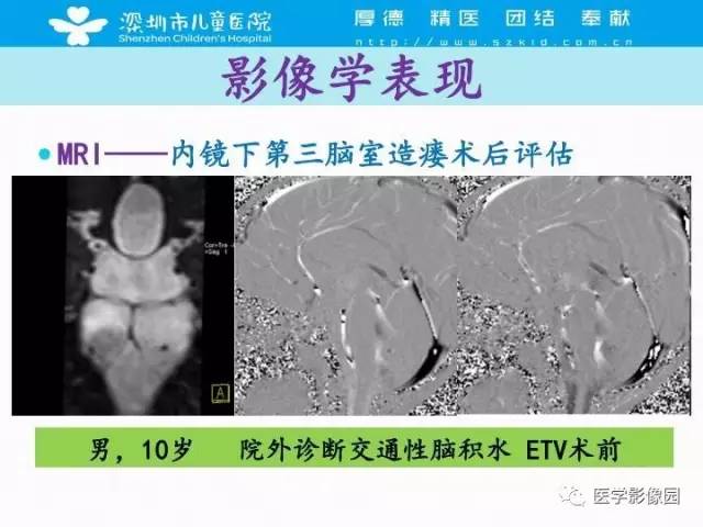 【PPT】儿童脑积水的MRI检查规范及新进展