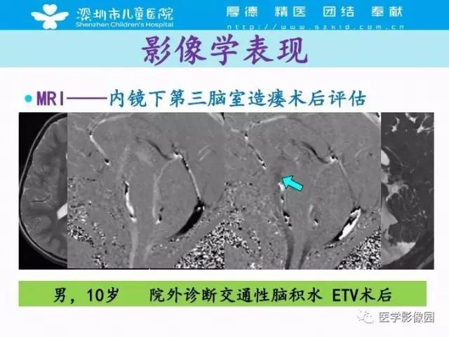 【PPT】儿童脑积水的MRI检查规范及新进展