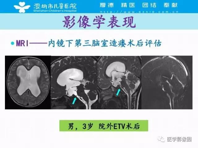 【PPT】儿童脑积水的MRI检查规范及新进展