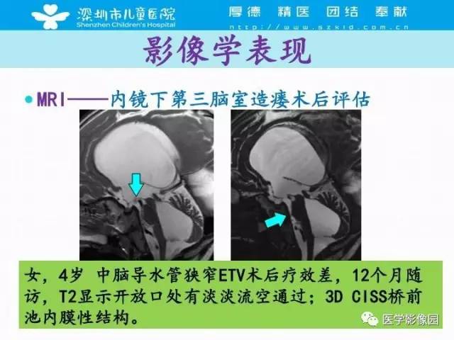【PPT】儿童脑积水的MRI检查规范及新进展