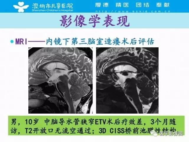 【PPT】儿童脑积水的MRI检查规范及新进展