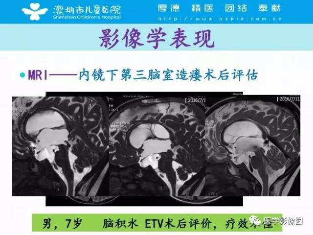【PPT】儿童脑积水的MRI检查规范及新进展