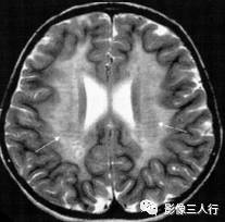 "虎纹征"，这个征象提示啥？