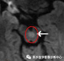 中脑这个常见的DWI高信号，您知道是为神马么？