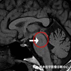 中脑这个常见的DWI高信号,您知道是为神马么? 中脑这个常见的DWI高信号,您知道是为神马么?