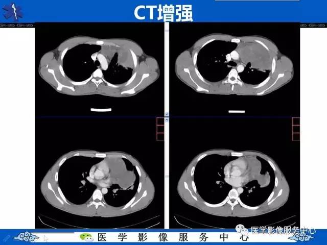 【病例】纵隔内胚窦瘤1例CT影像表现与鉴别